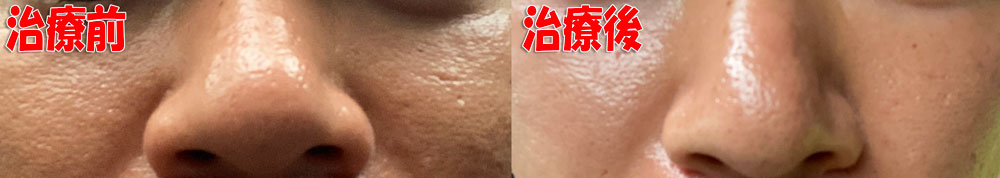 毛穴開き・黒ずみ治療の前後の肌の状態の写真撮影