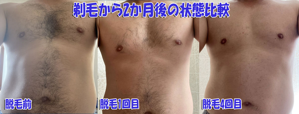 ★全身脱毛から2か月経過後の胸と腹の毛の生え状態_脱毛前＆脱毛1回目＆脱毛4回目