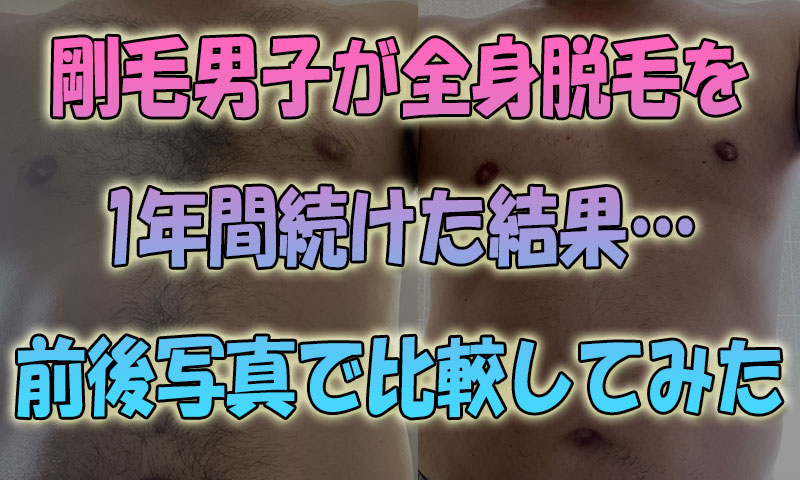 剛毛男子が全身脱毛を1年間続けた結果…生え具合を前後写真で比較してみた