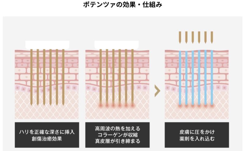 ポテンツァの効果・仕組み