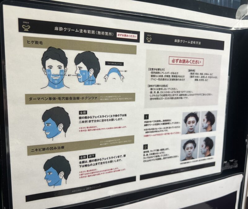 麻酔クリームの塗布の説明書